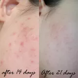 YOKO Крем против акне для локального применения | 7г | Acne Solution Emergency Spot Remover