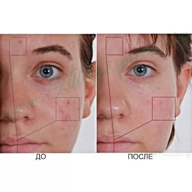 Ciracle Anti-Blemish Средство от воспалений, для точечного нанесения | 12мл | Anti-Blemish SPOT-X